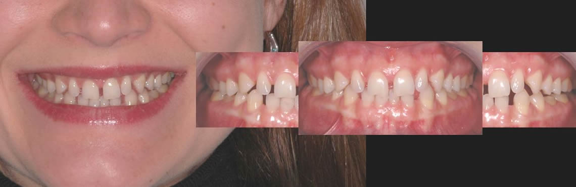 Smile Design