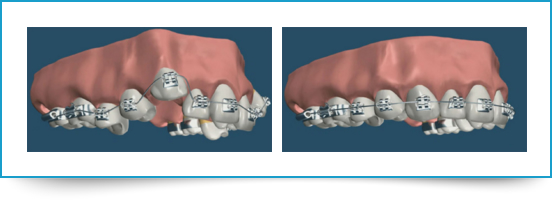 Ortodonzia Adolescenti